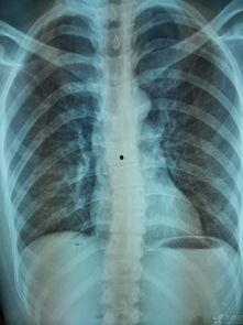 成人肠扭转检查方法视频,成人肠扭转诊断与检查方法视频解析